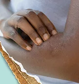 Atopic Dermatitis 101If you’ve got it, it’s time to learn how it can impact your daily life.